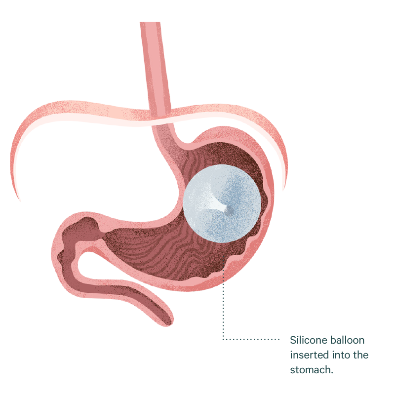 Intra Gastric Balloon Sydney Dr. Mark Magdy