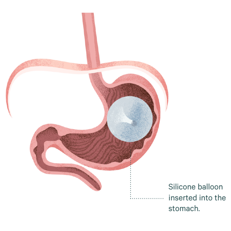 Intra Gastric Balloon Sydney | Dr. Mark Magdy